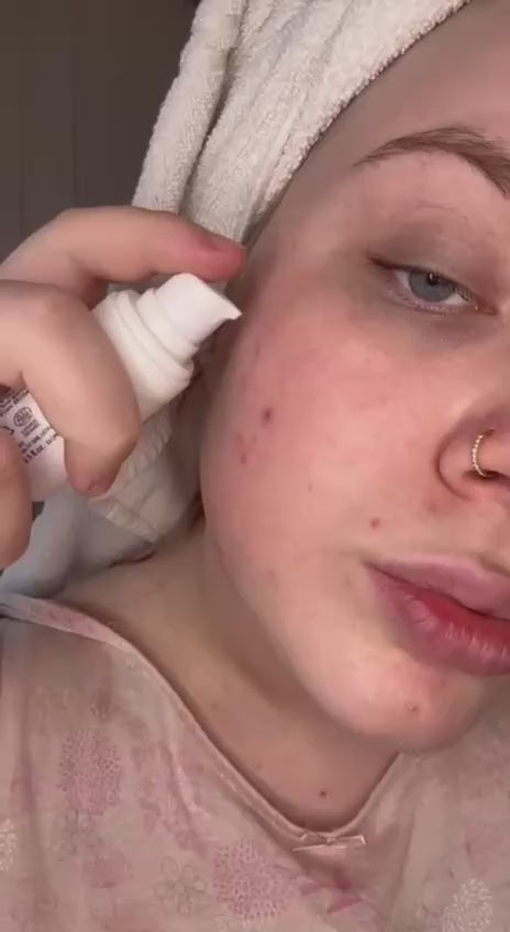 Video laden: Nur auf betroffene Stellen auftragen — Akne, Unreinheiten, Rötungen oder Pickel. Nicht auf das gesamte Gesicht auftragen.